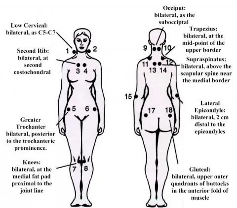 Costochondritis እና Fibromyalgia - በጎን በኩል ንጽጽር