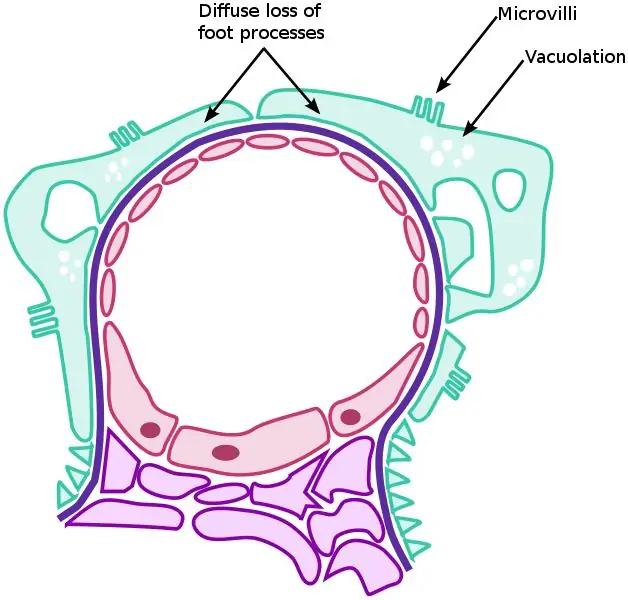 Különbség a glomerulonephritis és a nephrosis szindróma között